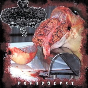 Pseudocyst